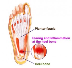 planterfasciitis