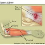 tennis_elbow