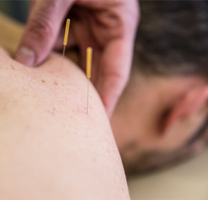 Dry Needling